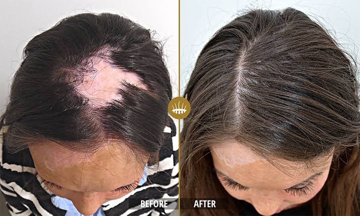 Scar Hair Transplant and Tissue Assessment